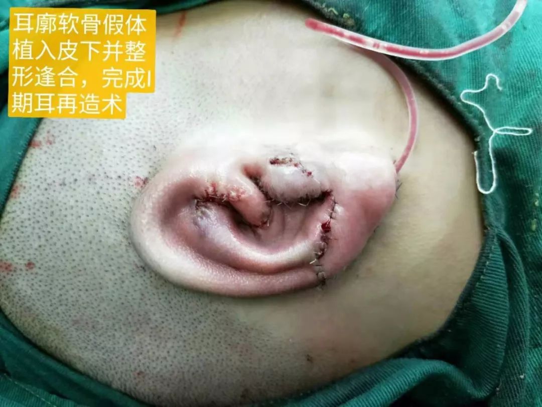 漳州15岁男孩先天右耳缺陷,医生用肋骨再造新耳朵!
