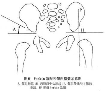 对于4个月以上婴幼儿,拍照骨盆前后位x线片,由专业骨科医生测量髋臼角