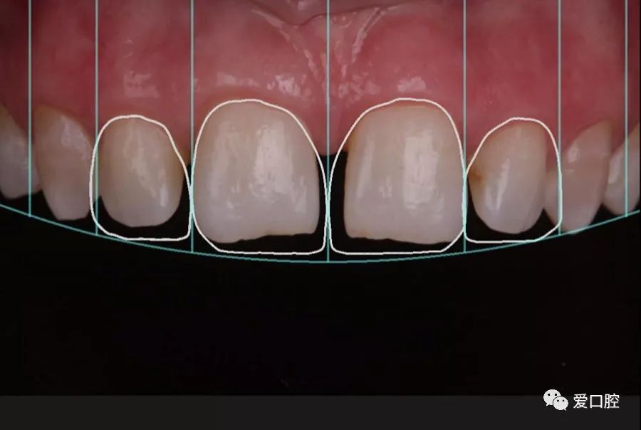 1121之间存在45mm间隙你该如何修复来看看国外大咖的修复病例