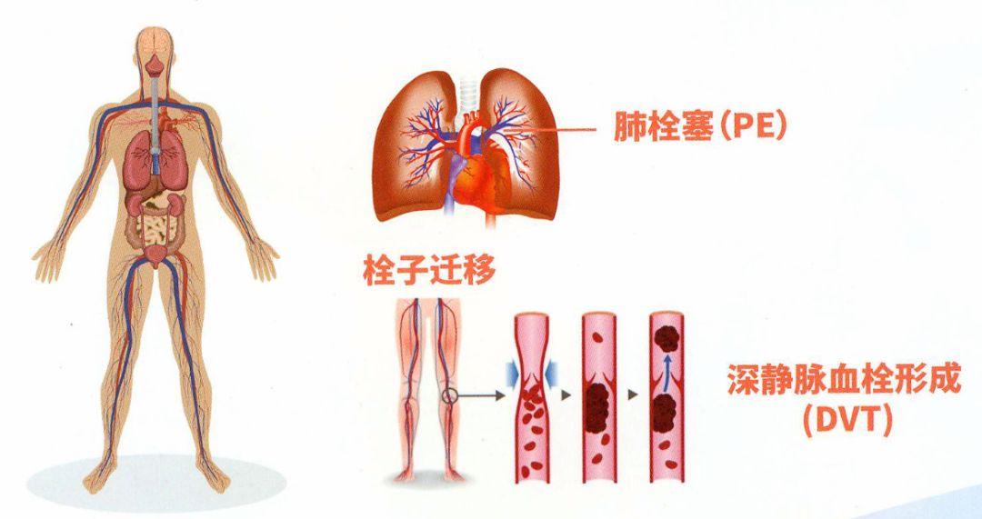 多于1/3的内科住院人群,都是vte的高危人群!