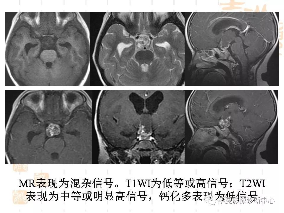 什麼是侵襲性垂體瘤mri徵象