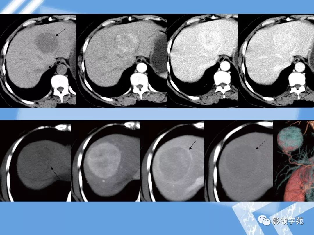 22种肝脏少见及不典型肿瘤的影像表现
