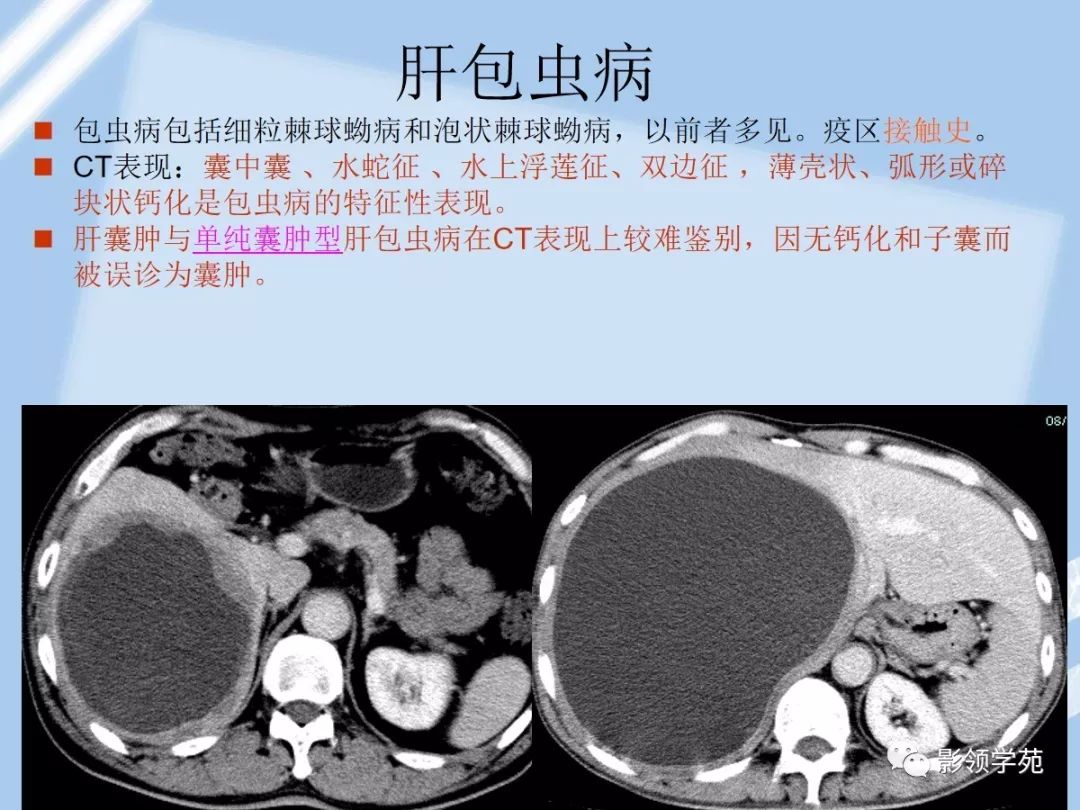 5,肝包虫病4,肾细胞癌肝转移肿瘤膨胀性生长,可有包膜,易出血,坏死,囊