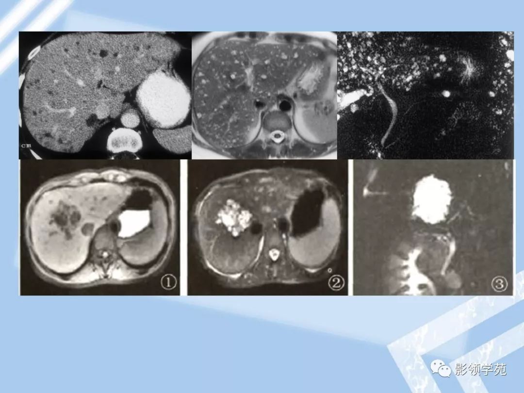 胆管错构瘤起源胚胎胆管,分布于肝实质,为胚胎时期肝内细小胆管发育