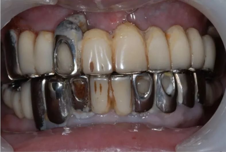 为什么很多牙科医生都在反对牙齿"美容冠"?