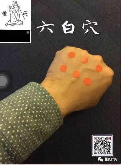 董氏针灸林正泰微课堂案例分享之手六白穴