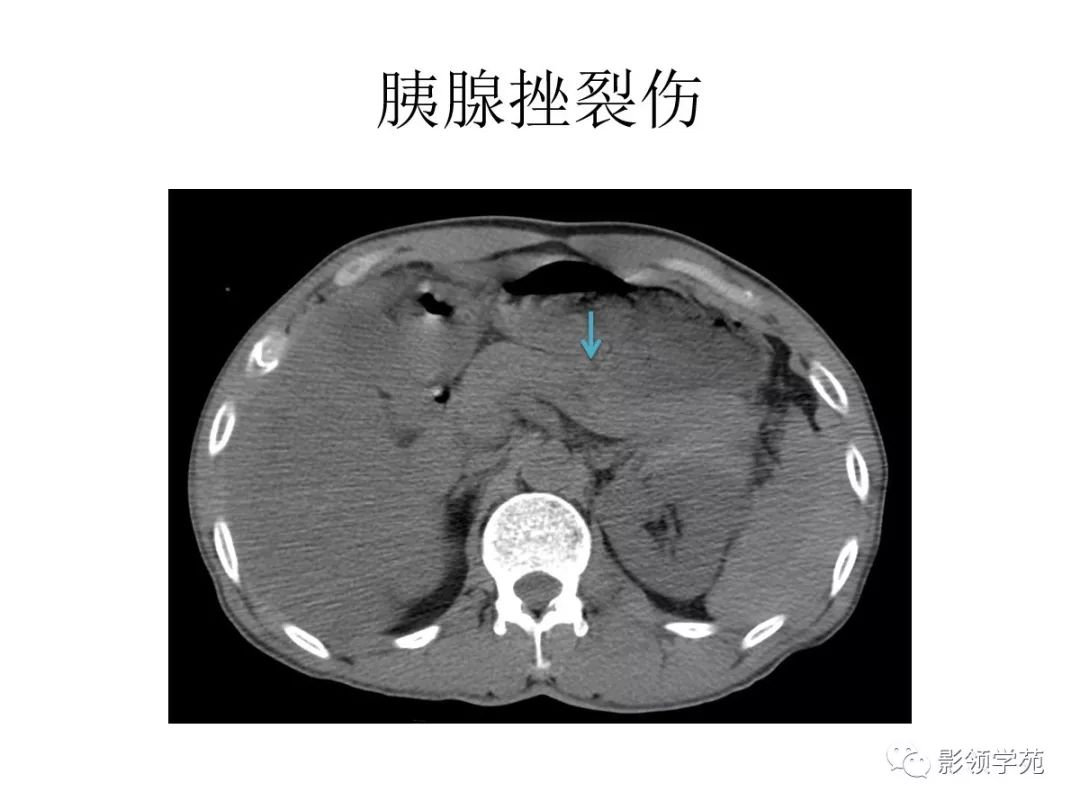 肾脏外伤ct表现:肾包膜下血肿(纤维膜内)肾周血肿(肾筋膜内)肾挫伤肾