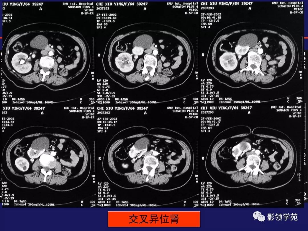 肾母细胞瘤 来自搜狐网