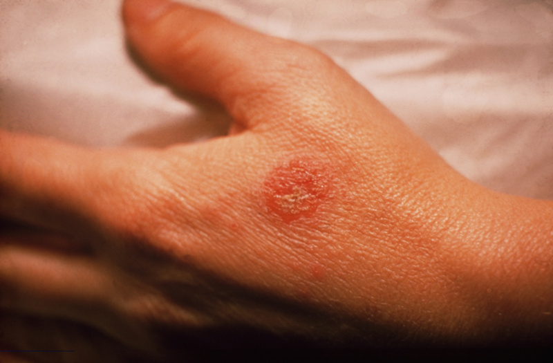 秋冬季节湿疹应该怎么办草本精粹皮清夫乳膏soeasy