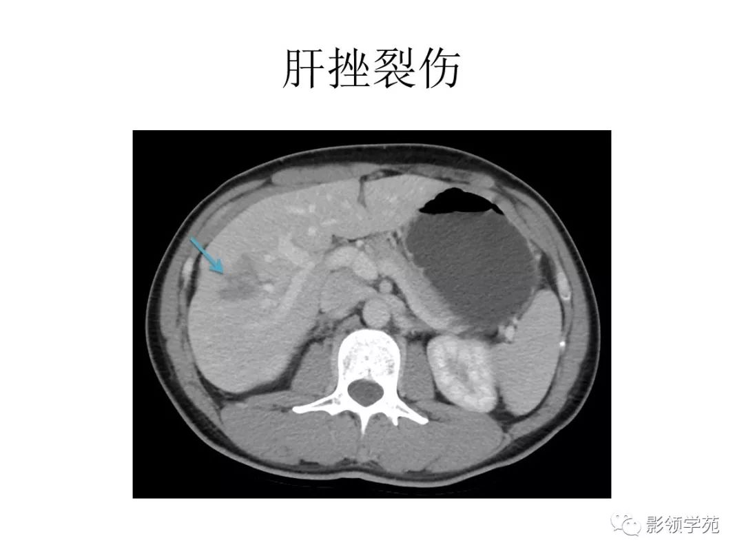 ct表现包膜下破裂中央破裂完全性破裂分类脾破裂肾脏泌尿系统胰腺肝脏