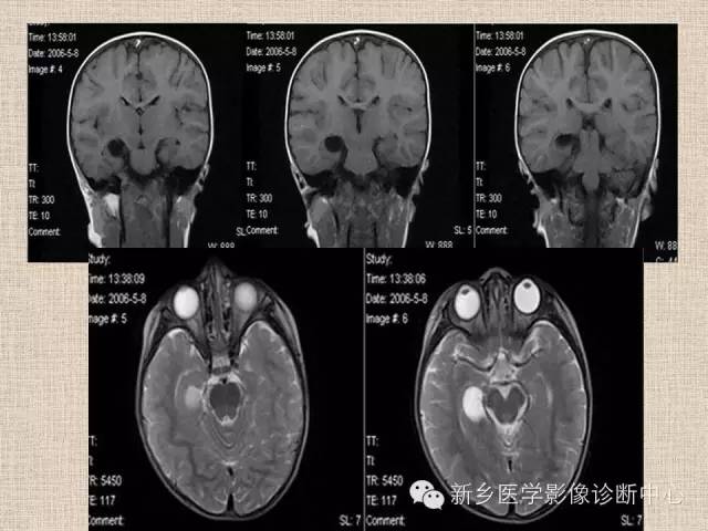 脉络膜裂囊肿位置图片