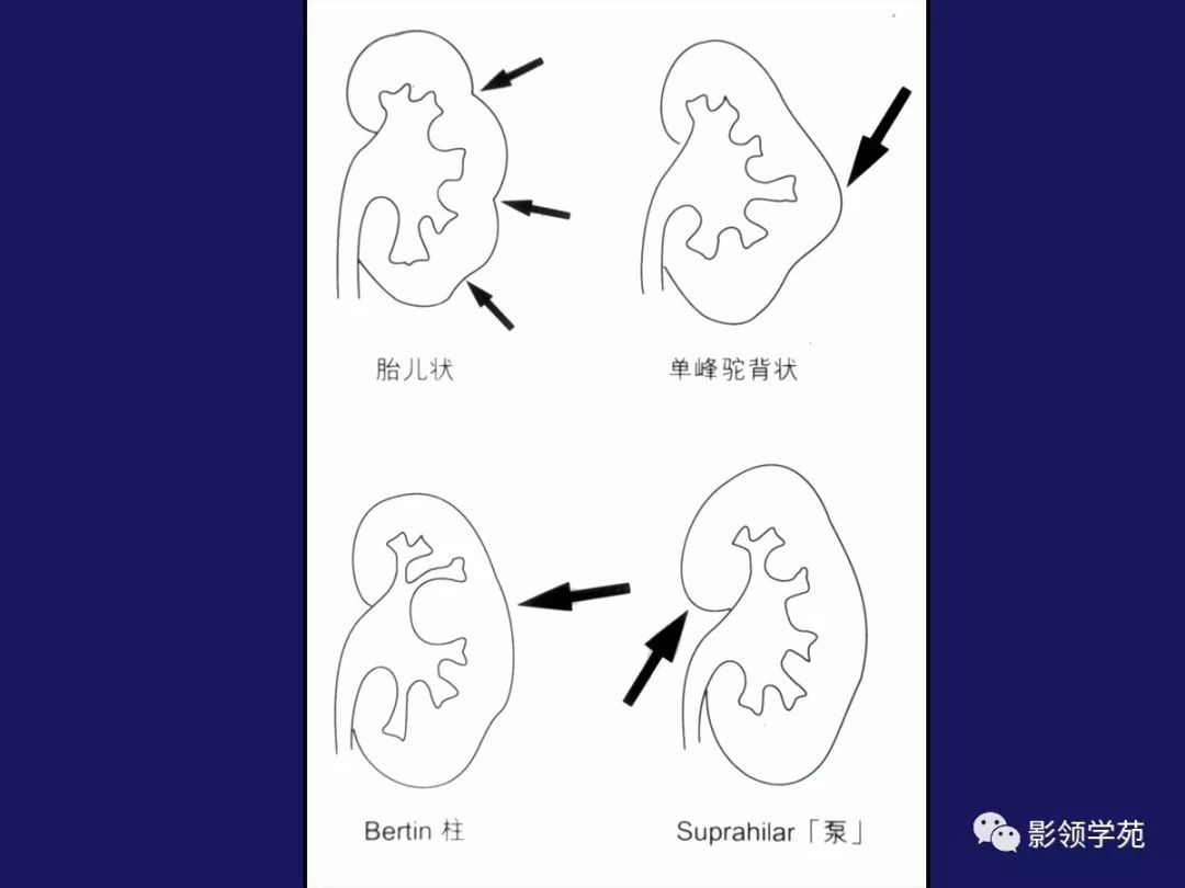 双肾盂 / 双输尿管畸形 double pelvic / double ureter肾母细胞瘤