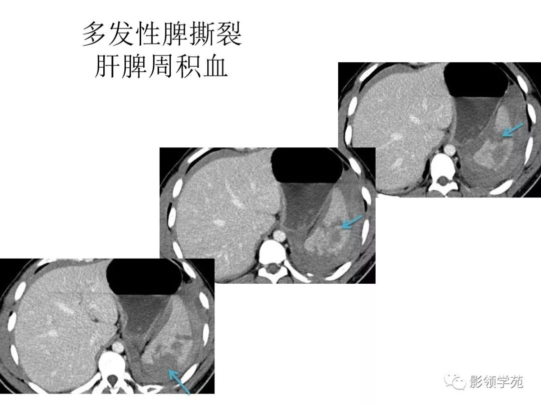 腹腔出血ct图片图片