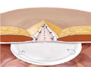 在腔镜下处理疝囊后,置入自固定补片完整覆盖缺损,利用腹压自动固定