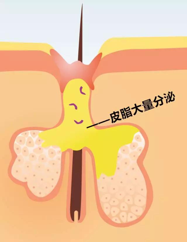 生长因子1(igf-1)含量升高,最终会引起表皮的过度角化和皮脂分泌增多