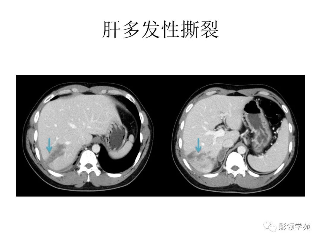 肝脏破裂ct图片图片