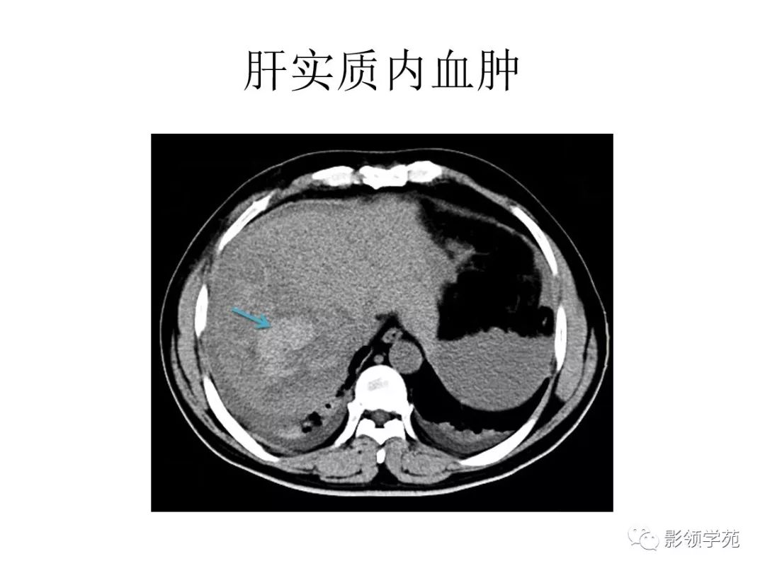 肝破裂ct图片