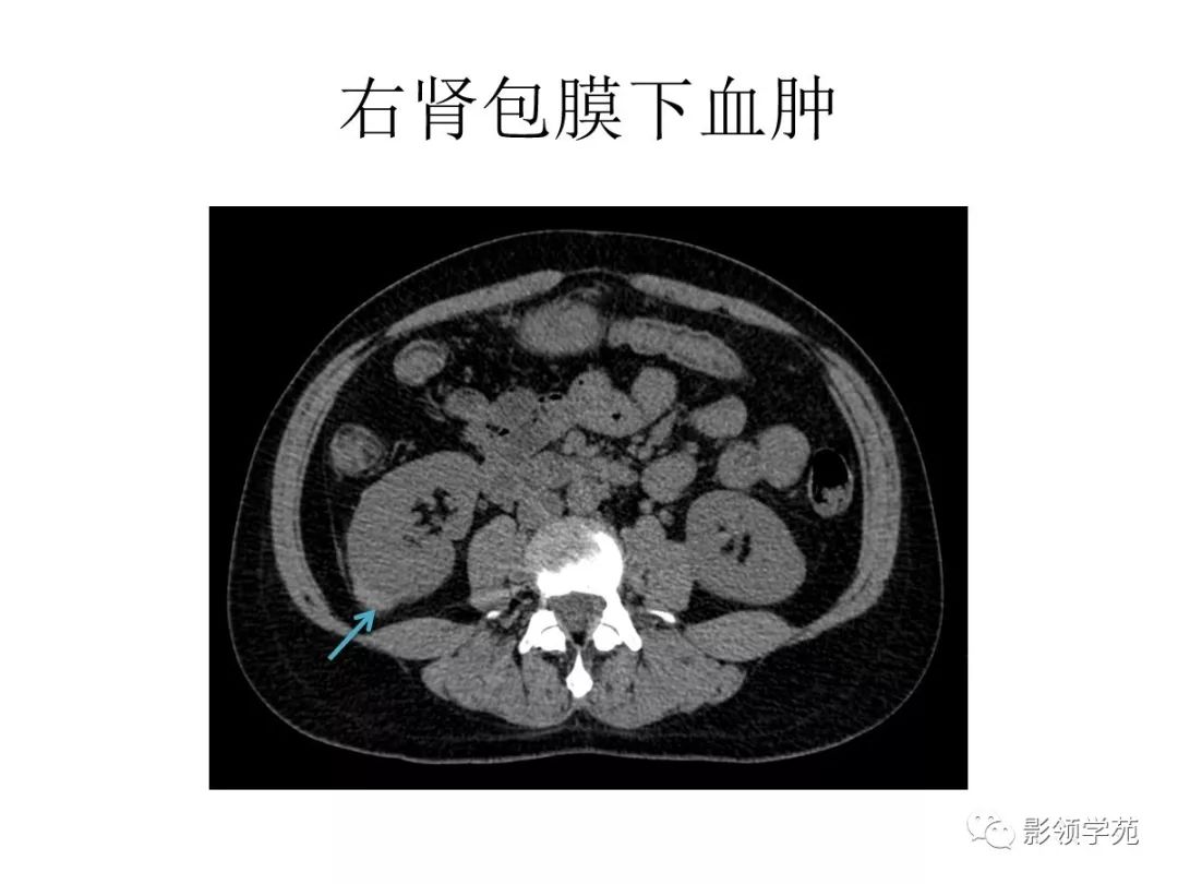 腹部实质性脏器外伤的ct表现