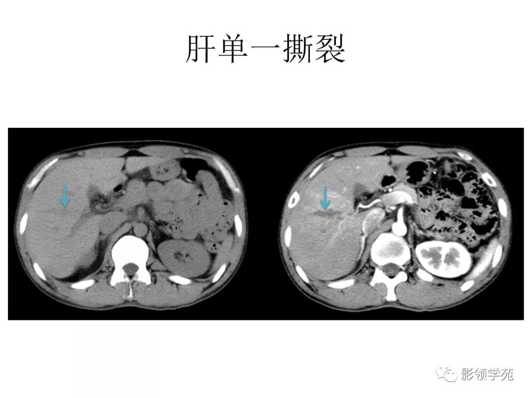 ct表现包膜下破裂中央破裂完全性破裂分类脾破裂肾脏泌尿系统胰腺肝脏