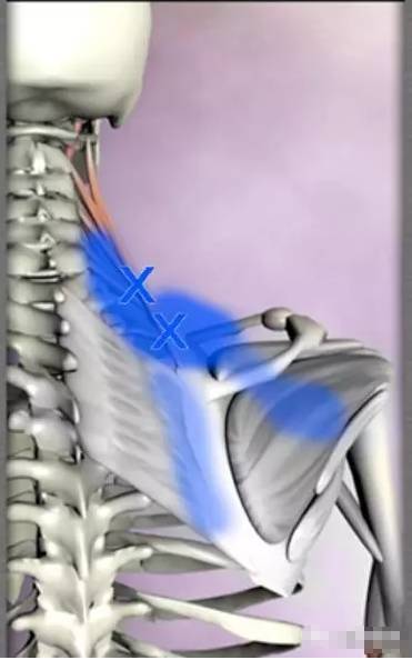 ③斜方肌和胸鎖乳突肌止點之間壓痛點或條索樣物可為治療點.