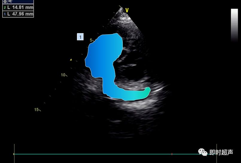 冠状静脉窦位置超声图图片