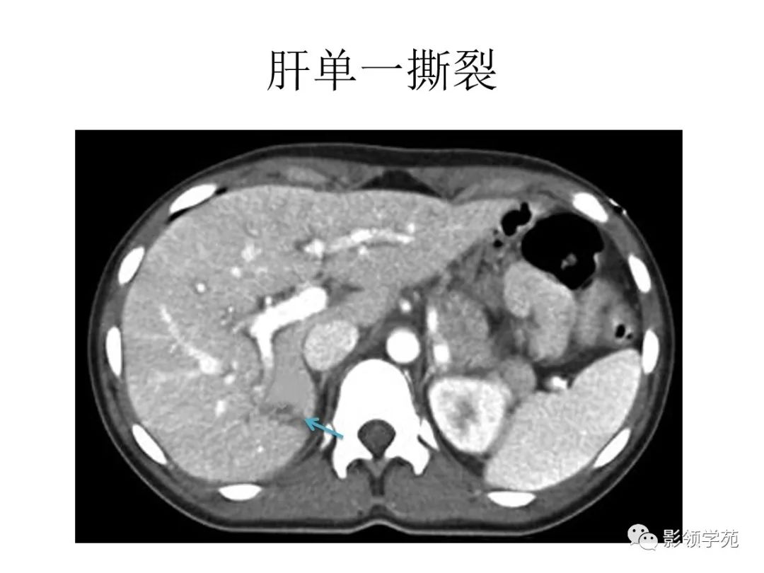 ct表现包膜下破裂中央破裂完全性破裂分类脾破裂肾脏泌尿系统胰腺肝脏