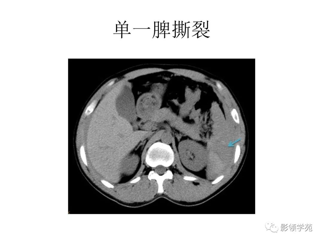 脾破裂ct影像表现图片图片