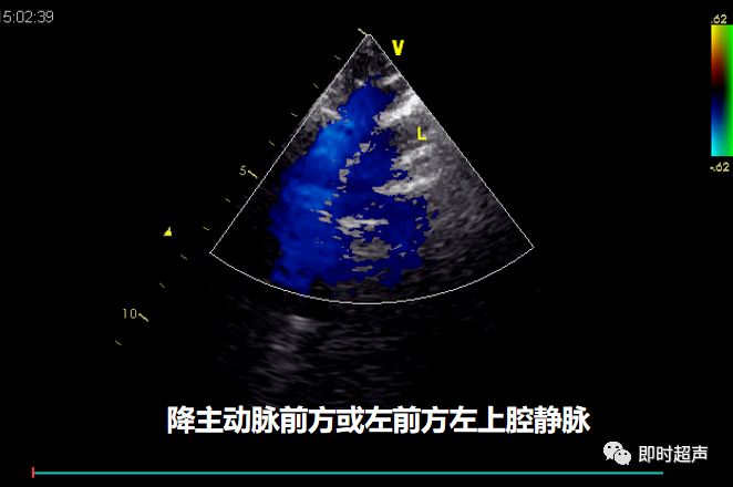 冠状静脉窦位置超声图图片