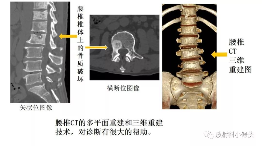腰椎ct横断面解剖图图片