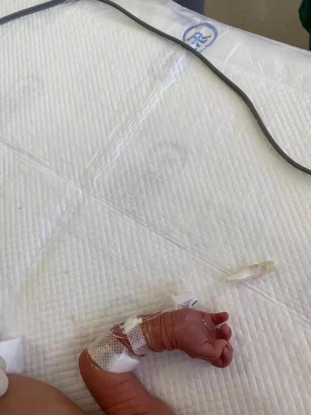 丽江首例新生儿picc置管术!市医院为出生7天早产患儿成功置管