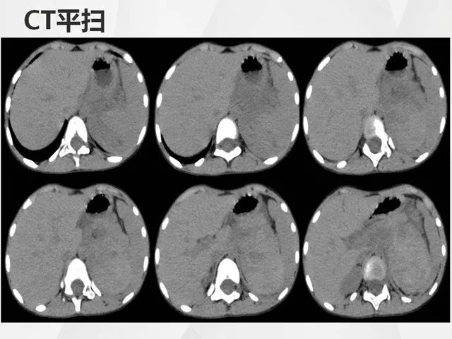 左侧肾上腺嗜铬细胞瘤等你分析