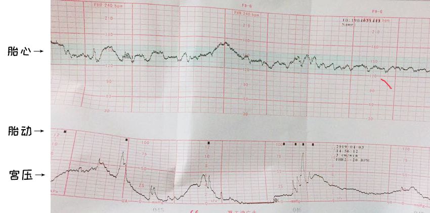 孕39周,我的宝宝缺氧了……关于胎监,这些你要懂