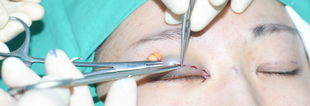 微创双眼皮重睑术和埋线有多大区别