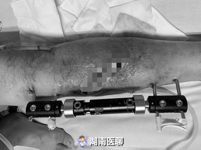 摔斷腿有可能致命男子骨折後不重視不料感染骨髓炎