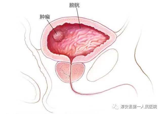 三个小孔切膀胱微创技术显神通