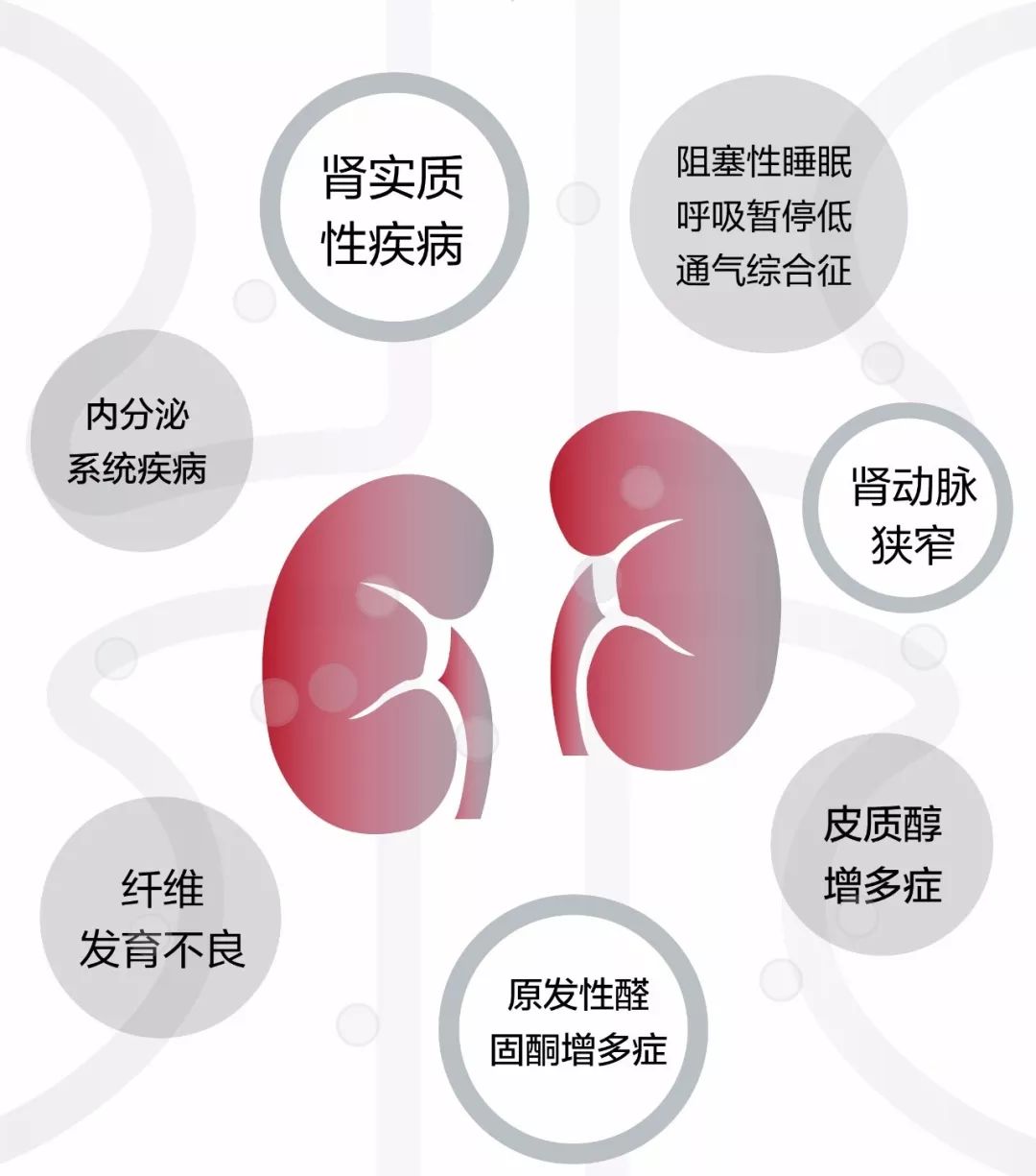 原醛症是由於腎上腺自主分泌過多醛固酮,導致水鈉瀦留,高血壓,伴或不