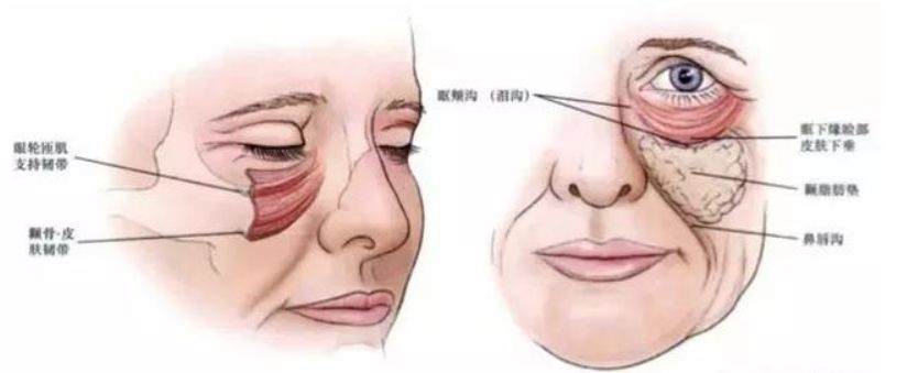 很多童鞋年轻的时候没有印第安纹,但随着年龄增长,皮肤筋膜层松驰,颧