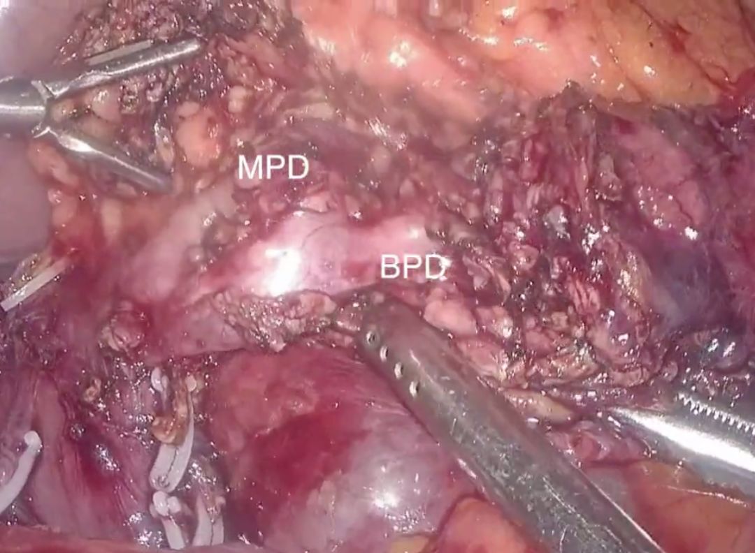 女神教你腹腔镜胰腺钩突切除术