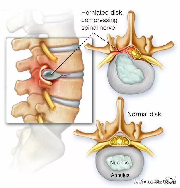 是弯腰搬重物时,椎间盘的压力升高2-3倍,因而极易导致椎间盘急性破裂