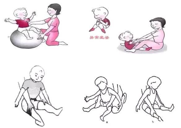 什么是小儿脑瘫,小孩脑瘫有哪些症状?又该如何预防宝宝患脑瘫