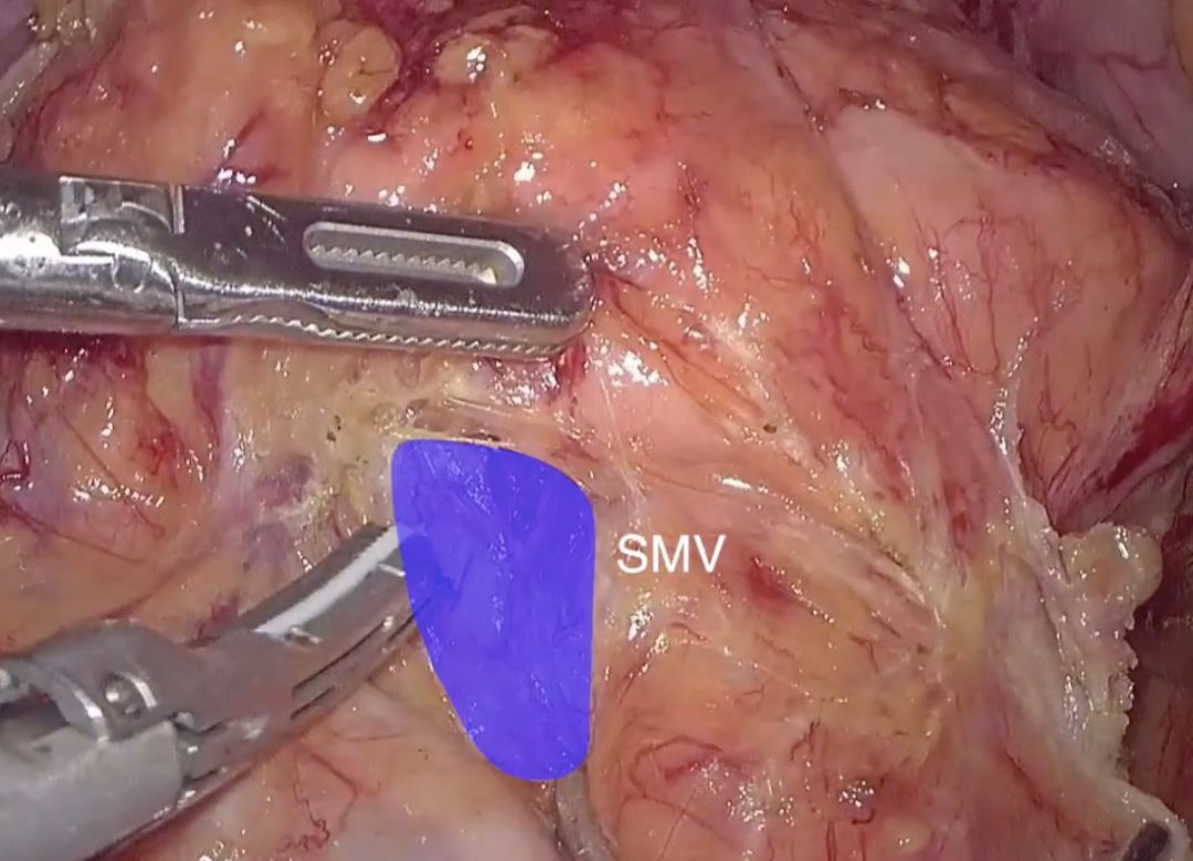 女神教你腹腔镜胰腺钩突切除术