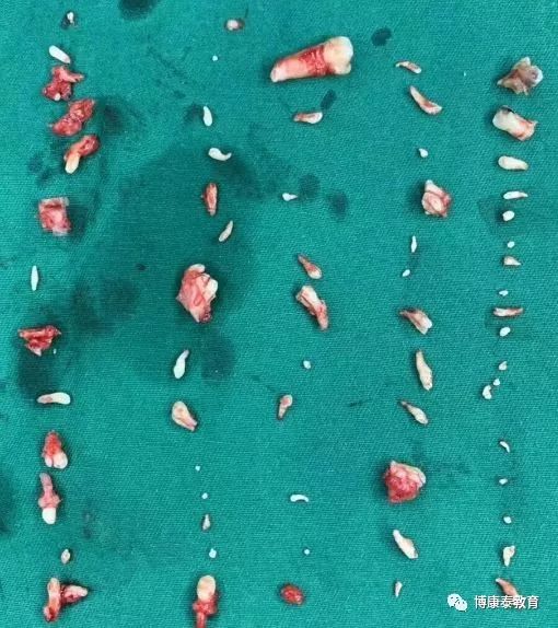 一般来说,成年人拥有28至32颗牙齿,超过此数即为"多齿症",多出来的