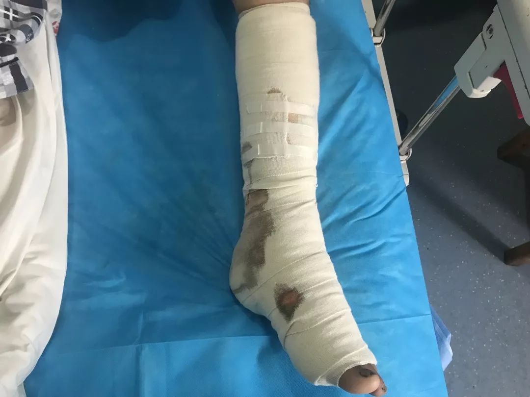 擦破黄豆大点皮湖南一男子差点截肢