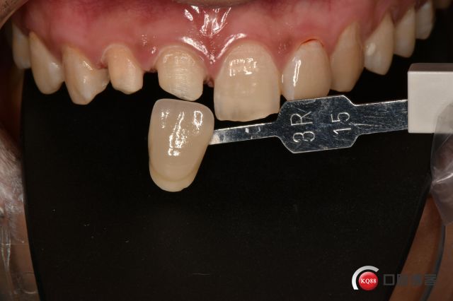 魅力前牙全瓷冠修复