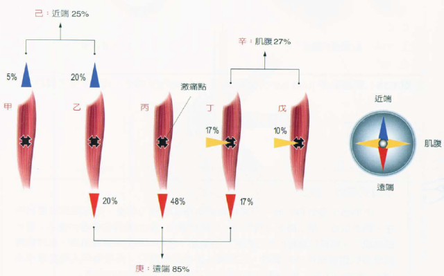 另眼看疼痛肌筋膜疼痛與激痛點