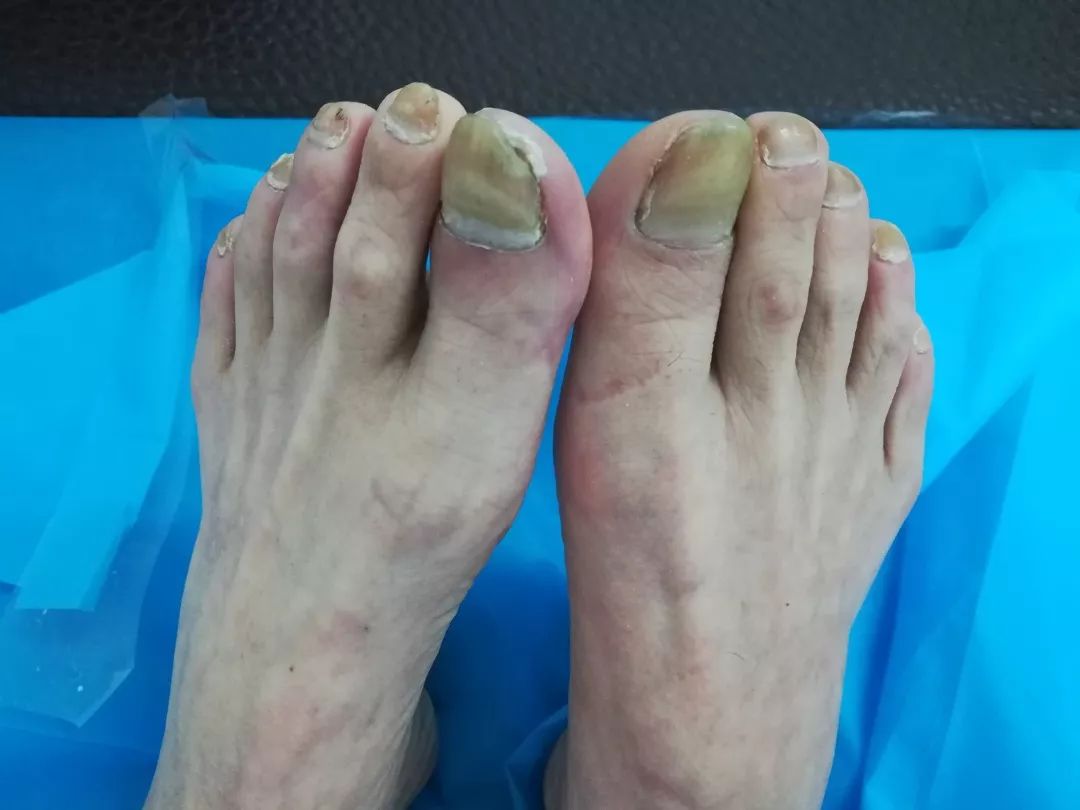 天冷腿脚疼警惕一类病治晚了轻者截肢重则丢命