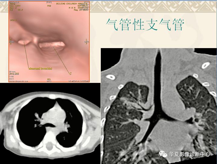 支气管隆突位置