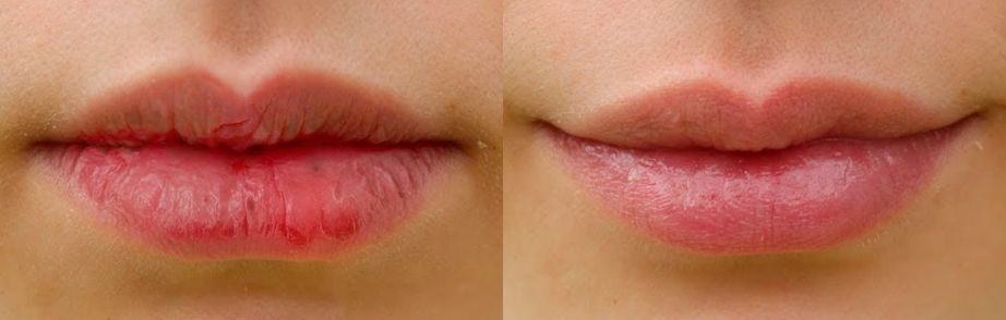 哪怕是反复发作的口角炎和唇炎,它都能搞定.