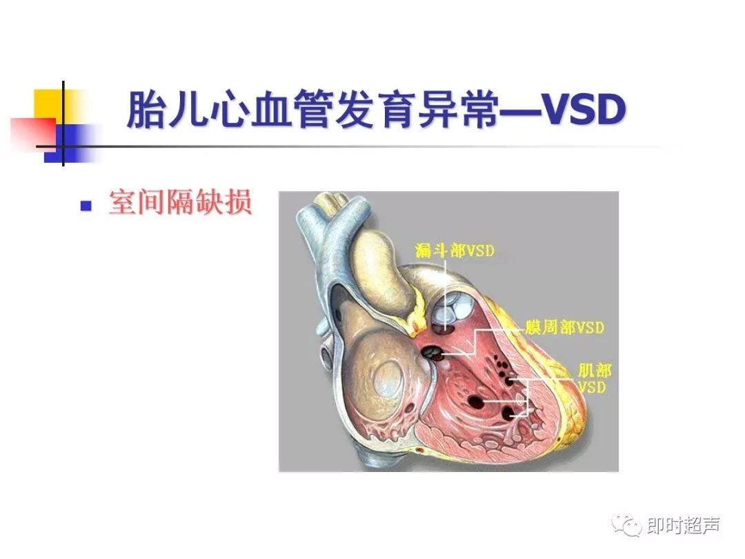 胎儿心脏结构异常