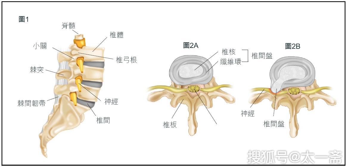 (3)椎间盘自身解剖因素的弱点:椎间盘在成人之后逐渐缺乏血液循环